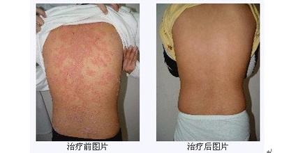 牛皮/癣的特色诊疗