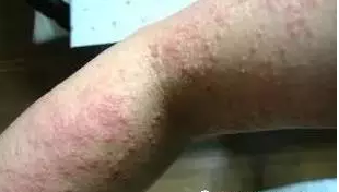 皮炎湿疹图片2