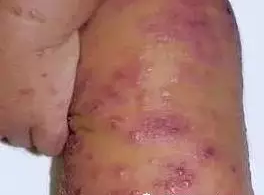 皮炎湿疹图片大全