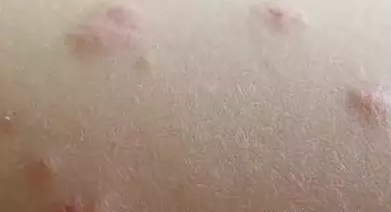 皮炎湿疹图片1