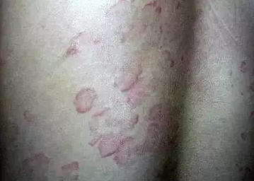皮炎湿疹图片5