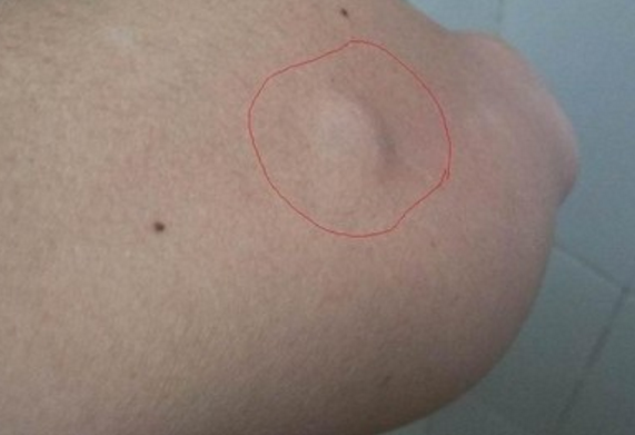 皮肤里有小肉疙瘩怎么回事