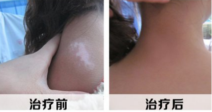 白/癜/风明显的症状有哪些？