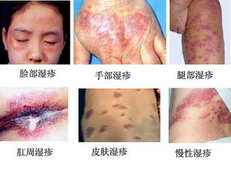 那么湿疹可以完全治愈吗?
