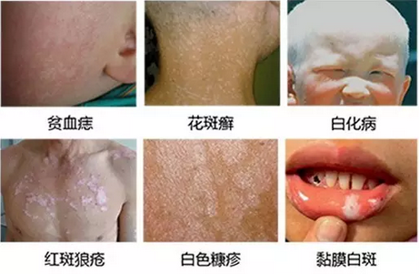 白癜风图片种类