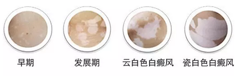 不同阶段的白癜风症状